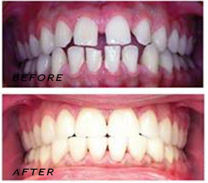 Antes y después. Tratamiento con carillas de cerámica de alta calidad | Clínica Dental Dra. Hotz Marbella (San Pedro de Alcántara)