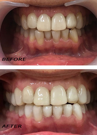 Antes y después. Carillas »Edelweiss« en la parte abajo optimizadas con láser | Clínica Dental Dra. Hotz Marbella (San Pedro de Alcántara)