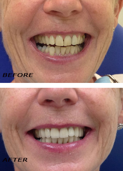 Antes y después. Carillas de cerámica de alta calidad | Clínica Dental Dra. Hotz Marbella (San Pedro de Alcántara)
