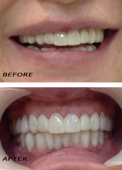 Antes y después. Carillas »Edelweiss« arriba y abajo optimizadas con láser | Clínica Dental Dra. Hotz Marbella (San Pedro de Alcántara)