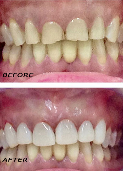 Antes y después. Carillas »Edelweiss« en la parte arriba optimizadas con láser. | Clínica Dental Dra. Hotz Marbella (San Pedro de Alcántara)