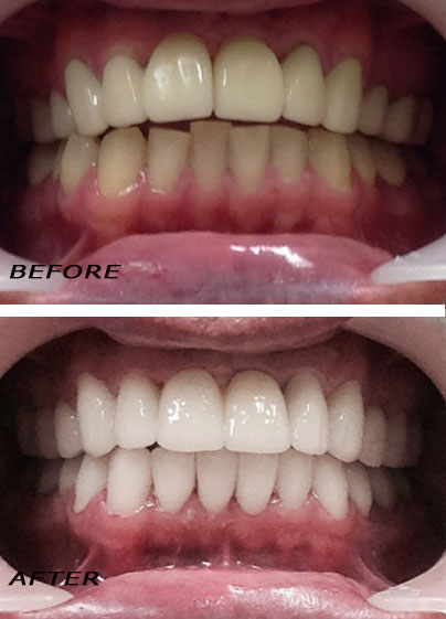 Antes y después. Coronas de cerámica de alta calidad. | Clínica Dental Dra. Hotz Marbella (San Pedro de Alcántara)