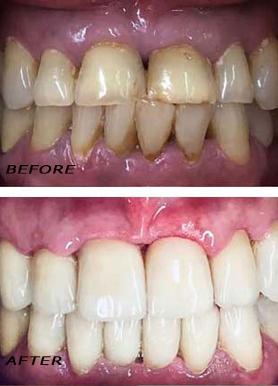 Vorher und Nachher. Behandlung mit hochwertigen Keramikkronen | Zahnklinik Dr Hotz Marbella, San Pedro de Alcántara