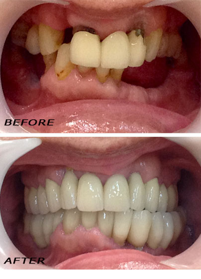 Vorher und Nachher. Komplette Zahnsanierung mit hochwertigen Zahnimplantaten und Keramikkronen | Zahnklinik Dr Hotz Marbella, San Pedro de Alcántara