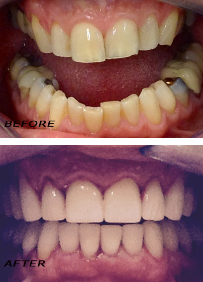 Vorher und Nachher. Zahnbrücke, Zahnimplantate und Kronen | Zahnklinik Dr Hotz Marbella, San Pedro de Alcántara