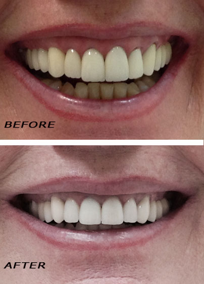 Antes y después. Puente dental, implantes dentales y coronas | Clínica Dental Dra. Hotz Marbella (San Pedro de Alcántara)