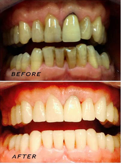 Vorher und Nachher. Komplette Zahnsanierung mit hochwertigen Keramikkronen | Zahnklinik Dr Hotz Marbella, San Pedro de Alcántara