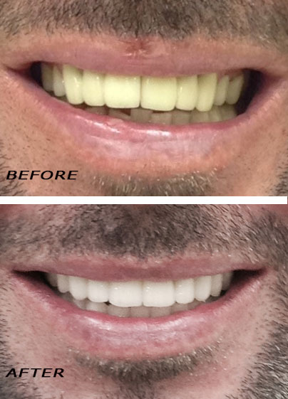 Antes y después. Renovación total con carillas y coronas de cerámica de alta calidad | Clínica Dental Dra. Hotz Marbella (San Pedro de Alcántara)