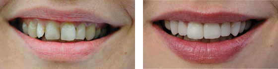 Carillas antes y después. Clínica Dental San Pedro de Alcántara (Marbella)