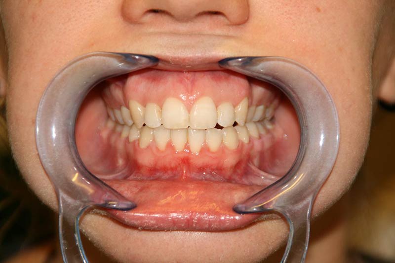 Después de la Ortodoncia. Clínica Dental Marbella.
