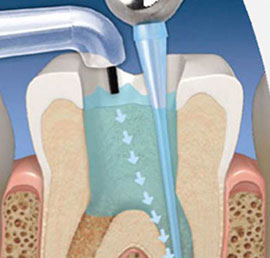 Root Canal Treatment Dentist Marbella