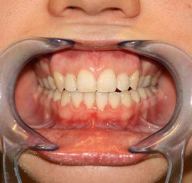 Photo gallery before and after dental treatments. Dentist Marbella