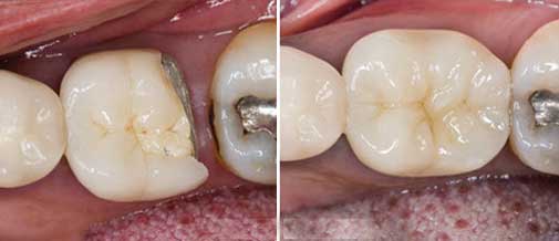 Con los empastes dentales podemos restaurar los dientes. Clínica Dental San Pedro de Alcántara (Marbella)