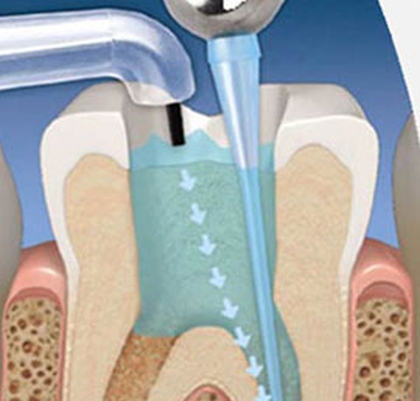 Tratamiento de conducto o la endodoncia Dentistas San Pedro, Marbella