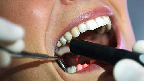 Zahnrestauration, Komposit kann man nahezu jeden Zahnschaden beheben. Deutsche Zahnärztin Marbella, San Pedro de Alcántar