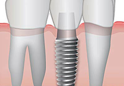 Implantología oral - los implantes dentales. Clínica Dental San Pedro de Alcántara (Marbella)