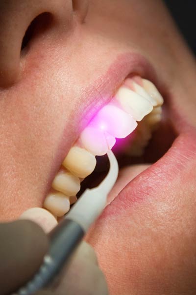 Tratamientos con Láser Dental en Odontología. Clínica Dental San Pedro de Alcántara (Marbella)