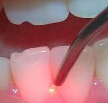 Zahnbehandlung mit Laser - Deutsche Zahnärztin Marbella, San Pedro de Alcántara