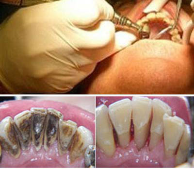 Dental Preventiva, odontología preventiva, la limpieza dental profesional. Clínica Dental San Pedro de Alcántara (Marbella)