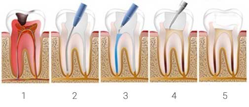 La caries dental se extiende hasta la pulpa del diente. Clínica Dental San Pedro de Alcántara (Marbella)