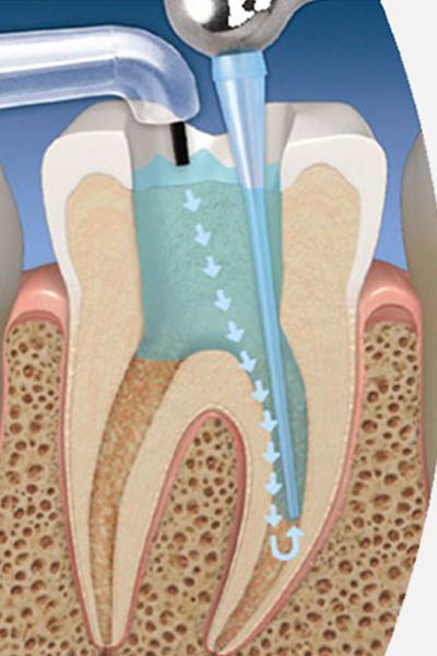 Tratamiento de Conducto - Endodoncia. Clínica Dental San Pedro de Alcántara (Marbella)