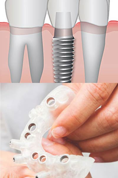 Implantology Marbella. Dental Implants prevent other teeth from being harmed.